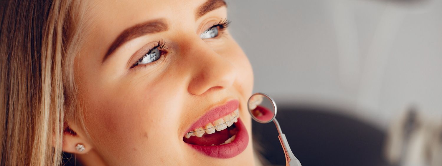 estetica dentale, faccette